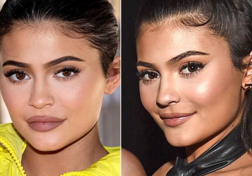 Can Filler Last Forever? Understanding the Lifespan of Lip Fillers