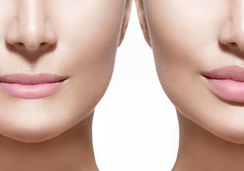 Will Your Face Return to Normal After Fillers?