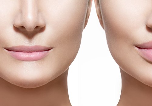 How long after fillers do you see results?